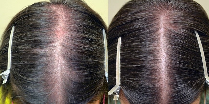 Женский лосьон для роста волос MinoX 2%, 200 мл 18 фото