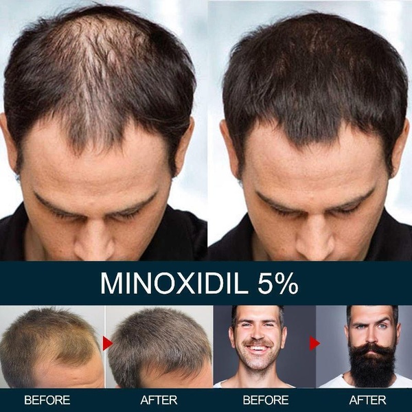 Лосьйон для росту волосся Minox 5%, (200 мл, вистачає на 4 місяці) 19 фото