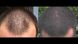 Лосьон-спрей для роста волос Minox 5% (200мл, хватает на 4 месяца) 19 фото 5