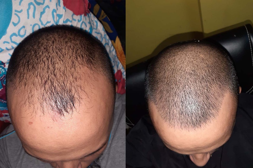 Лосьйон для росту волосся Minox 10% (200мл, вистачає на 4 місяці) 21 фото