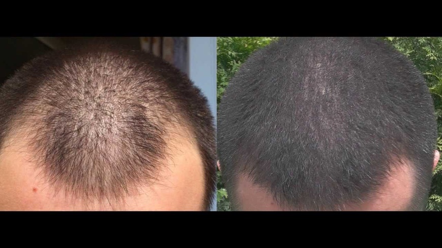 Комплекс для росту волосся для чоловіків 991891 фото